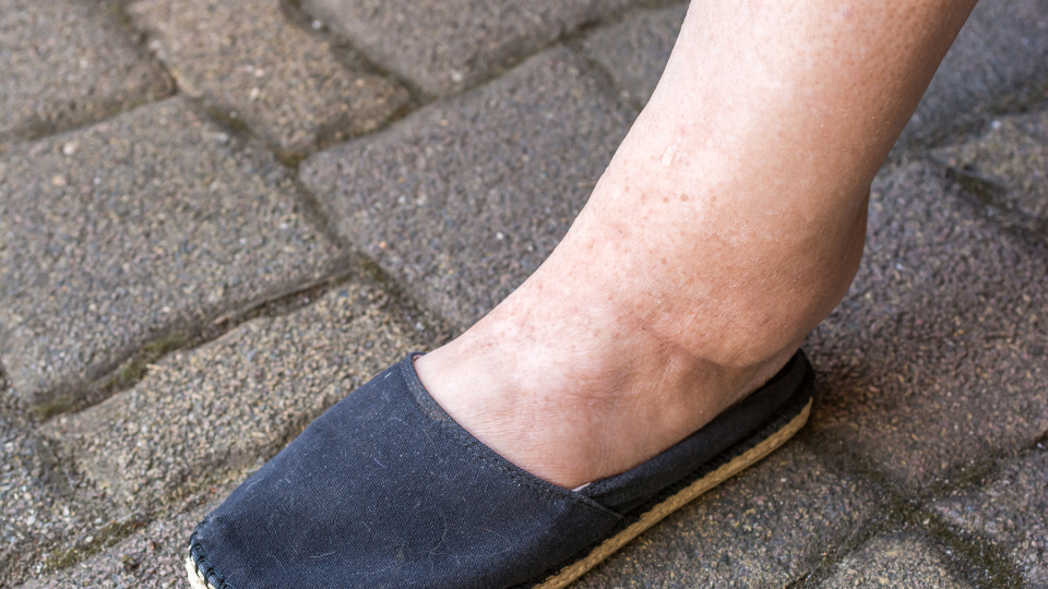 Wassereinlagerungen in den Beinen und was man dagegen tun kann